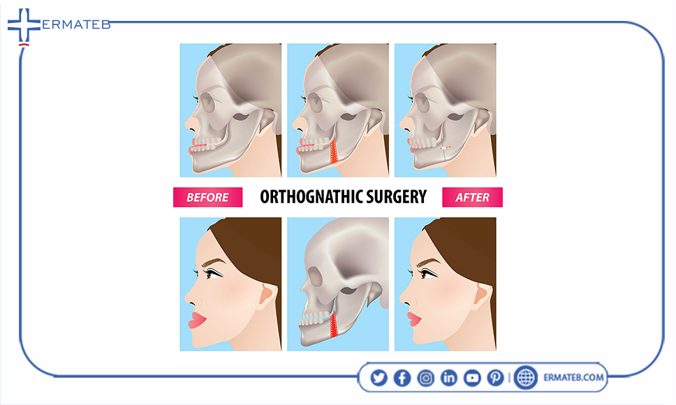 orthognathic surgery and jawline surgery 2